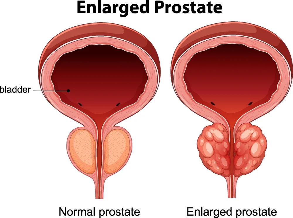 Prostate Artery Embolization in Van Nuys CA