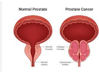 Prostate Specialist in Irvine CA